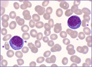 Peripheral blood film showing 'Turk' cells.