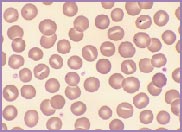 Hereditary stomatocytosis Macrocytic stomatocytes as well as post-splenectomy changes, in a case of hereditary stomatocytosis (hydrocytosis).