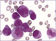 Acute promyelocytic leukaemia bone marrow Abnormal promyelocytes with hypergranulated cytoplasm and some bilobed nuclei